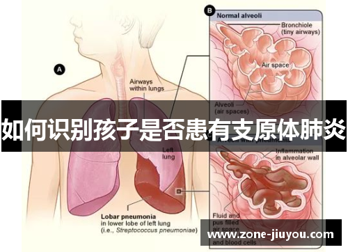如何识别孩子是否患有支原体肺炎